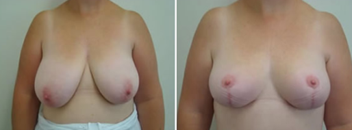 Breast Reduction Mammoplasty images,  image 31, patient 11 before and after mammaplasty, front view