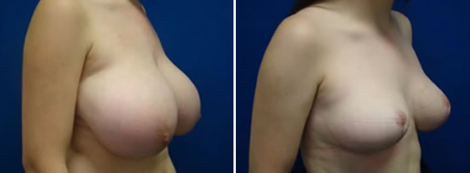 Patient Breast Reduction Mammoplasty before and after images, image 36, angle view