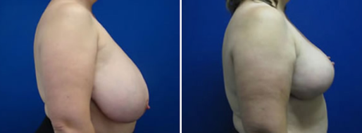 Breast Reduction Mammoplasty before and after image, patient 14, side view