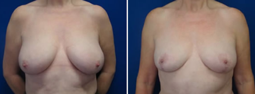 Breast Reduction Mammoplasty patient 17, Dr Norris Sydney