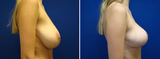Patient 19, image 48, Breast Reduction Mammoplasty before and afterimages, with Dr Norris