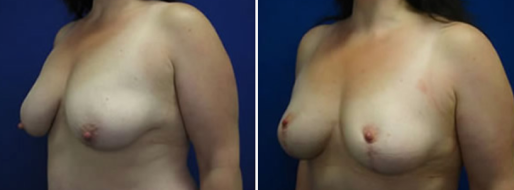 Breast Reduction Mammoplasty before and after images, patient 20, angle view, image 51