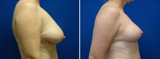 Dr Norris, Breast Reduction Mammoplasty patient before and after surgery images, image 06, side view