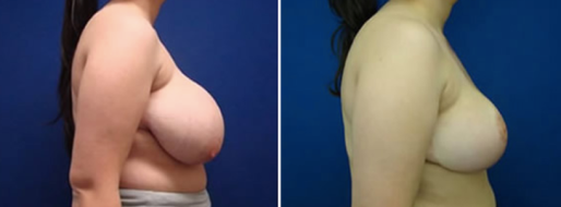 Patient 24, Breast Reduction Mammoplasty before and afterimaage, image 60, side view
