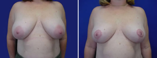 Breast Reduction Mammoplasty images, patient 26, front view