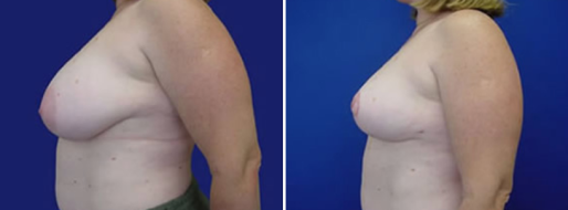 Breast Reduction Mammoplasty, before and after image, patient 26, side view