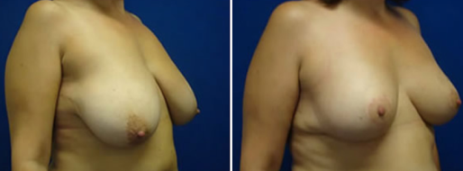 Breast Reduction Mammoplasty images, patient 03, image 08, angle view