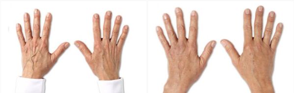 Patient before and after dermal fillers to hands, image 01