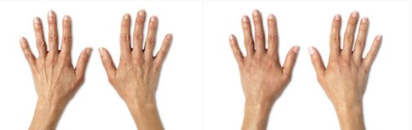 Dermal fillers to hands, before and after image 02
