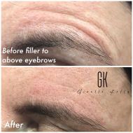 Filler-above-eyebrows-client-21