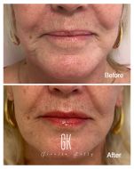 Filler-to-corners-mouth-and-lip-borders-client-55