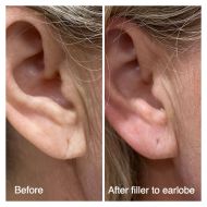 Filler-to-ear-lobes-client-48