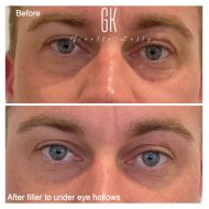 Filler-to-under-eye-hollows-client-47
