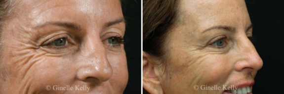 Dermal fillers to cheeks, before and after image 04