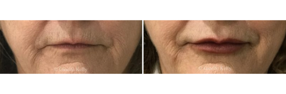 Patient before and after lip fillers, image 09