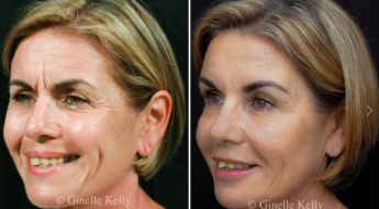 Dermal fillers before and after (full-face rejuvenation), angle view