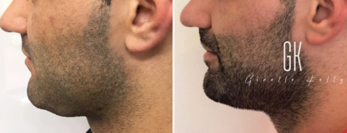 Chin Fat Reduction  before and after images, image 01, side view