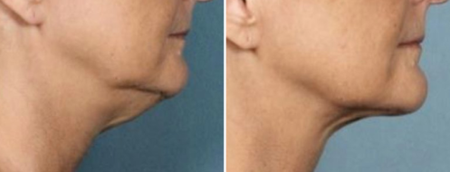 Non-surgical Chin Fat Reduction treatment, image 05, patient before and after treatment images