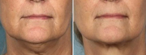 Form & Face patient, Chin Fat Reduction before and after images, image 06