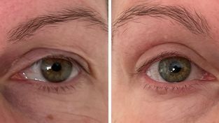 Dr Norris, Blepharoplasty (Eyelid surgery)  surgery photos,  Patient P, before and after images