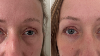 Eyelid Surgery Photos 1 Lower Blepharoplasty female (Eyelid Surgery)