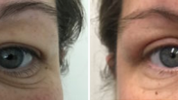 Eyelid surgery before and after image 11, before and after gallery, Dr Norris