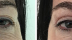 Blepharoplasty, patient 12, image gallery, before & after surgery