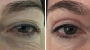Blepharoplasty (Eyelid surgery)  photos, patient J, image gallery, before & after Eyelid surgery