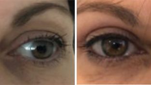 Upper eyelids, patient M, Blepharoplasty (Eyelid surgery) Before and After  images