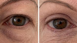 Blepharoplasty (Eyelid surgery)  photos, patient D, image 020