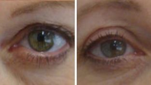Blepharoplasty (Eyelid surgery)  photos,  patient H, before and after photo