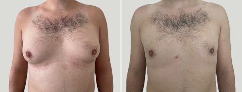 Male Breast Reduction (Gynaecomastia Correction) before and after images, front view