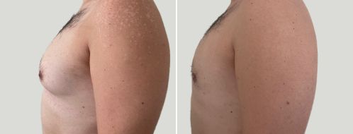 Male Breast Reduction (Gynaecomastia Correction) before and after images, Left view