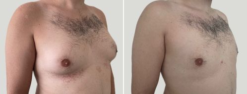 Male Breast Reduction (Gynaecomastia Correction) before and after images, Angle view