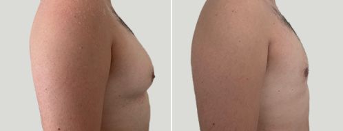 Male Breast Reduction (Gynaecomastia Correction) before and after images, Right view