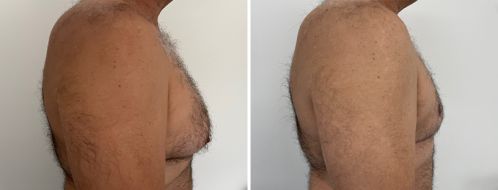 Male Breast Reduction (Gynaecomastia Correction) before and after images, side view
