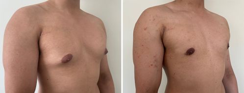 Male Breast Reduction (Gynaecomastia Correction) before and after images, angle view