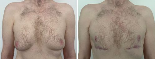 Male Breast Reduction (Gynaecomastia Correction) before and after images, front view