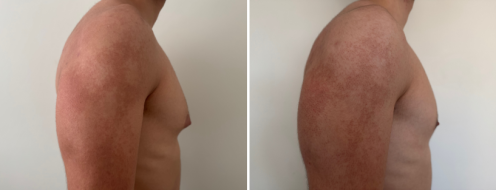 Male Breast Reduction Photos 1 Gynaecomastia, Side view, Grade 1.