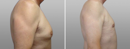 Male breast reduction before and after photo 11, patient 05, side view