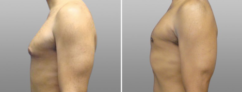 Male Breast Reduction (Gynaecomastia Correction), Dr Norris Sydney, patient 07, side view