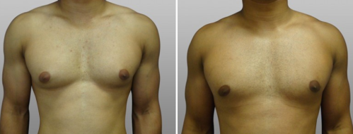 Male breast reduction, image gallery, patient 08, front view