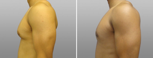 Male Breast Reduction (Gynaecomastia Correction) patient 08, Dr Norris, before & after images