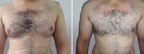 Male Breast Reduction (Gynaecomastia Correction) before and after images, patient 11, image 20