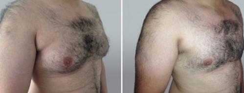 Male Breast Reduction (Gynaecomastia Correction) patient 11, image 21, angle view