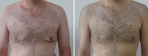 Male Breast Reduction (Gynaecomastia Correction), patient 13, image 27, front view