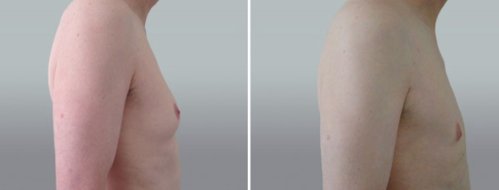 Image 31, Male Breast Reduction (Gynaecomastia Correction) results, patient 14, Form & Face Sydney