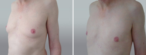 Male Breast Reduction (Gynaecomastia Correction) images, patient 14, image 32, angle view