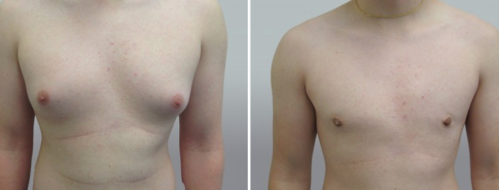 Male Breast Reduction (Gynaecomastia Correction) before and after images, patient 15, front view, image 33