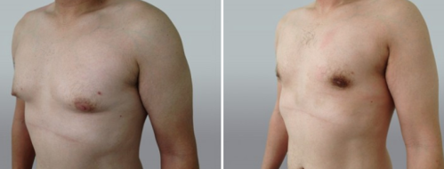 Male Breast Reduction (Gynaecomastia Correction) before and after images, patient 16, angle view, image 36